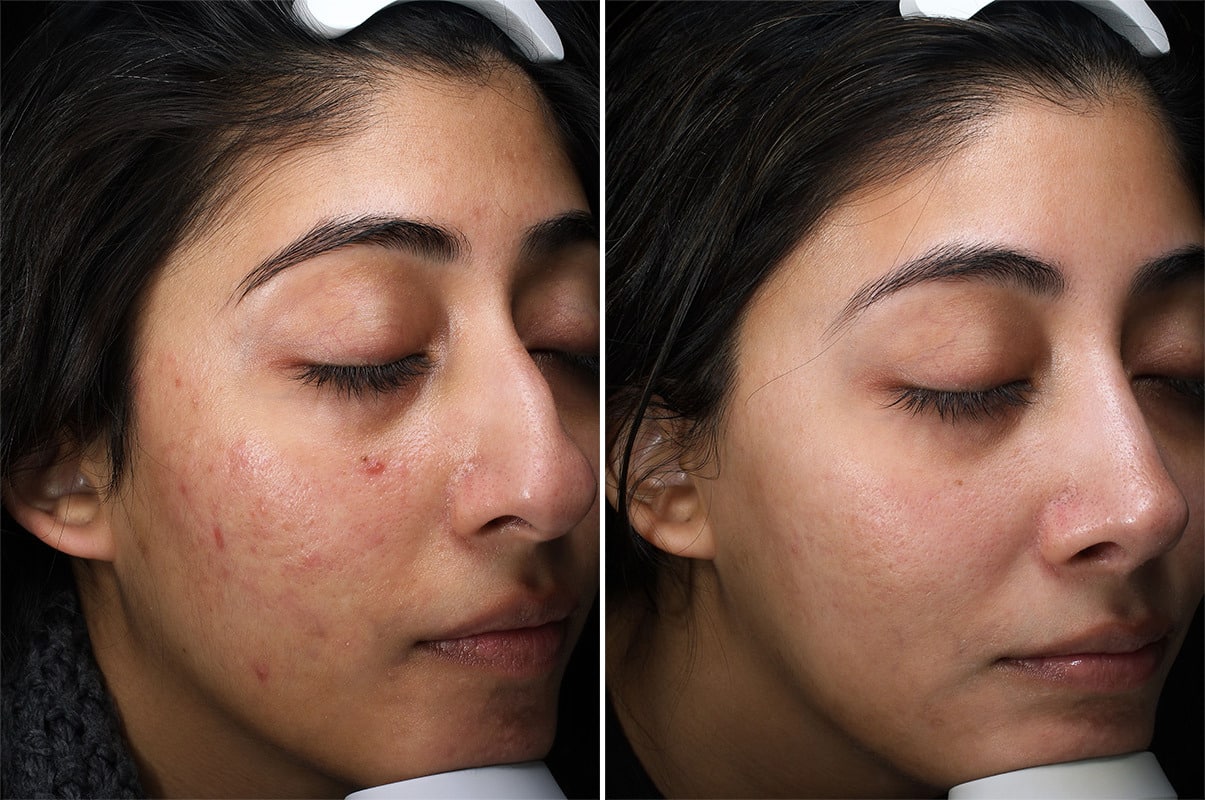 patient-37094-chemical-peels-before-after