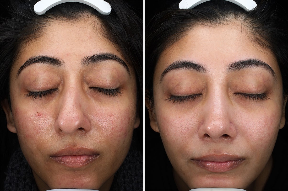 patient-37094-chemical-peels-before-after