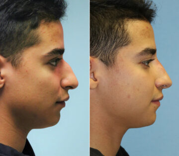 Before and after Male Injections by Dr. Shervin Naderi, Patient 11871