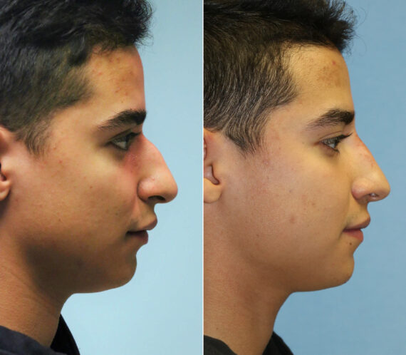Before and after Male Injections by Dr. Shervin Naderi, Patient 11871