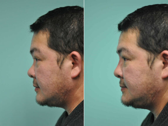 Before and after Male Injections by Dr. Shervin Naderi, Patient 12030
