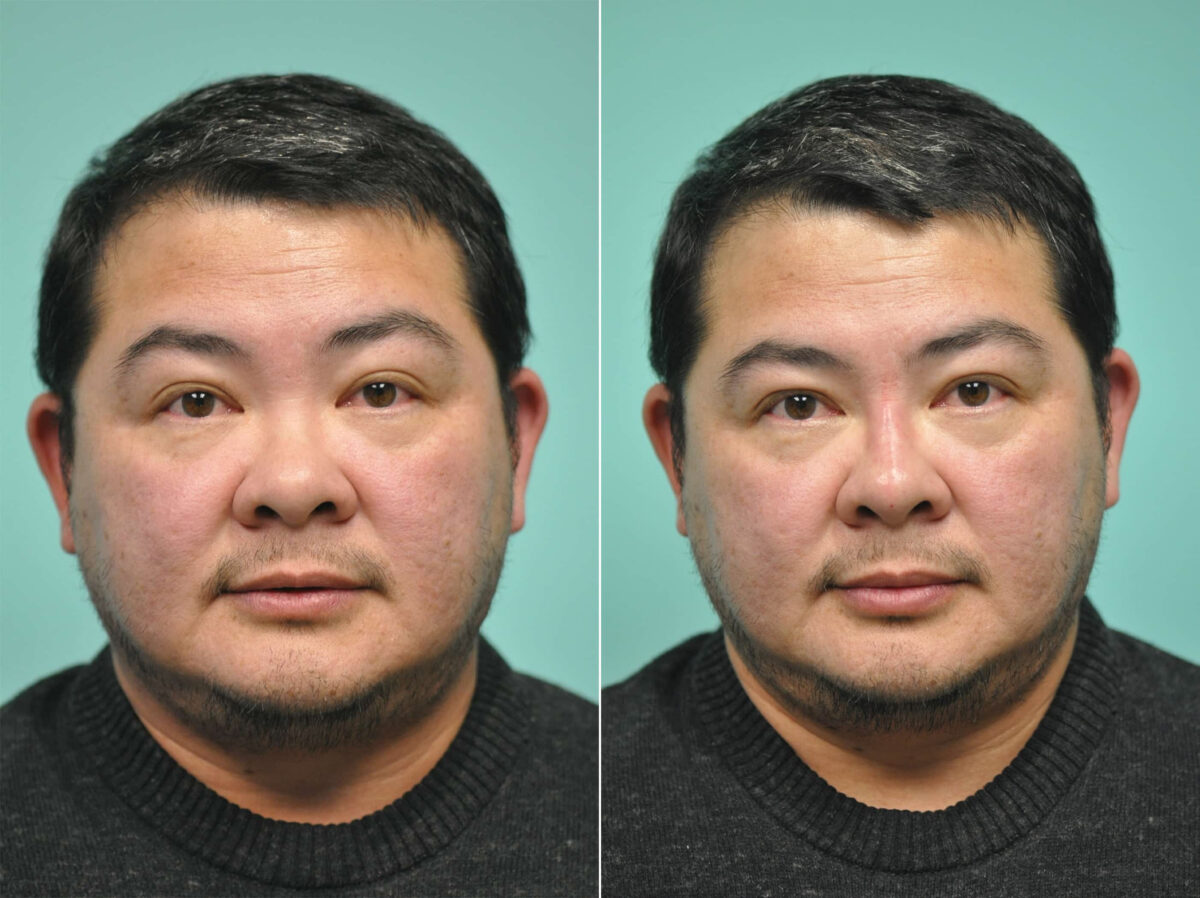 Patient 12030, Male Injections Before and After Photos Before and after Male Injections by Dr. Shervin Naderi, Patient 12030