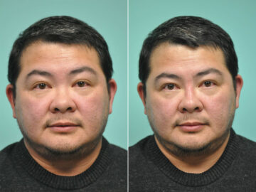 Before and after Male Injections by Dr. Shervin Naderi, Patient 12030