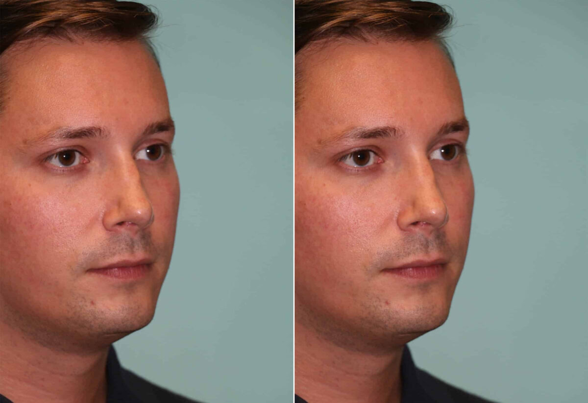 Before and after Male Injections by Dr. Shervin Naderi, Patient 12047