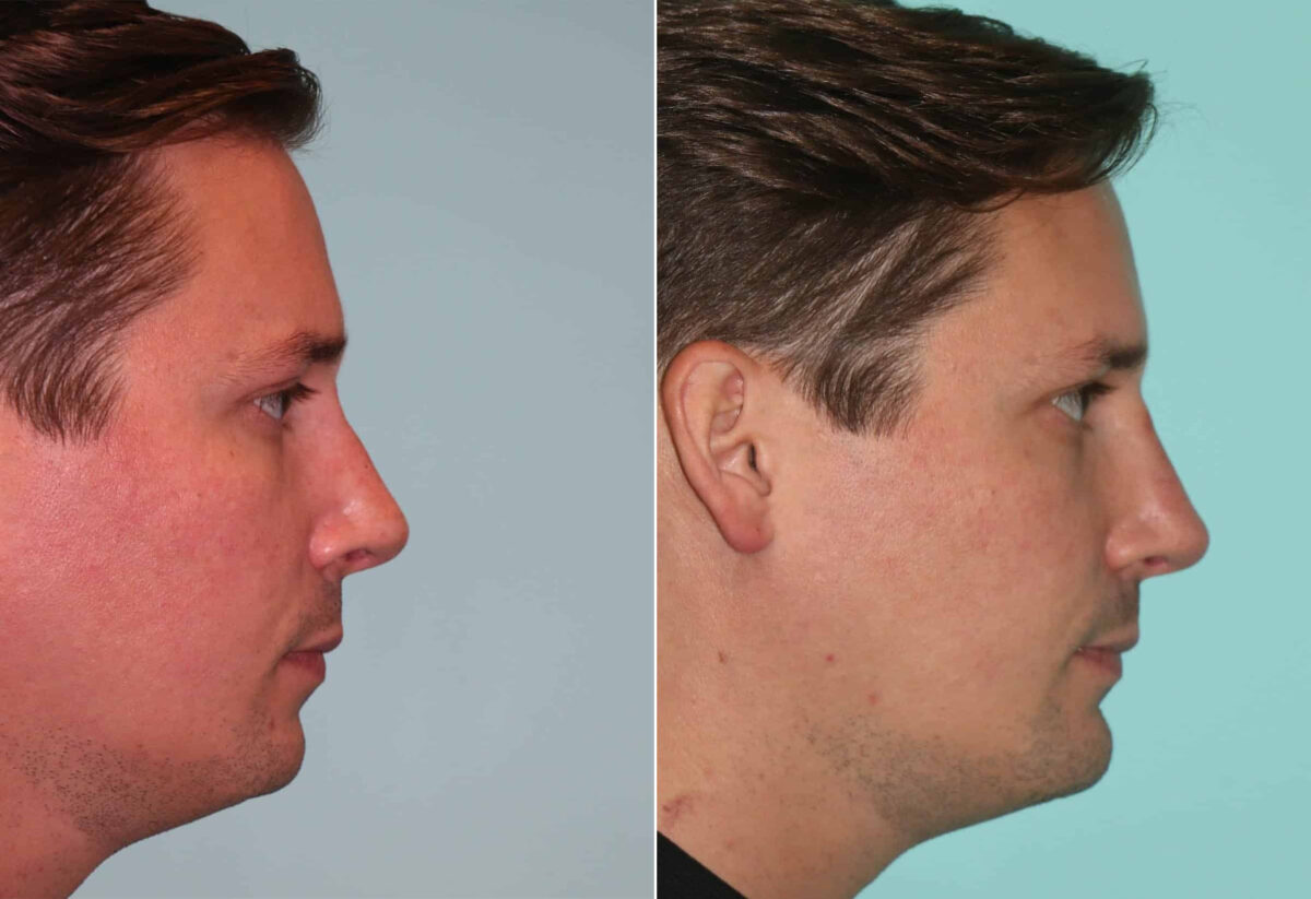 Before and after Male Injections by Dr. Shervin Naderi, Patient 12047