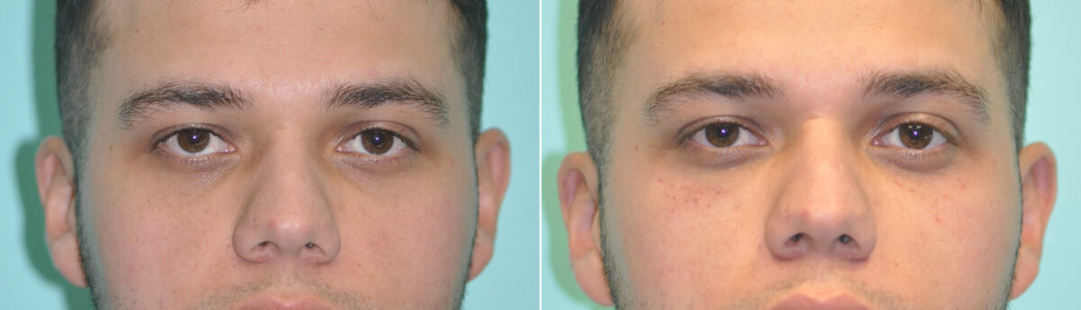 Patient 12138, Injections Before and After Photos Before and after Injections by Dr. Shervin Naderi, Patient 12138