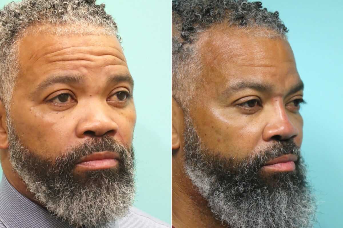 Before and after Male Injections by Dr. Shervin Naderi, Patient 17640