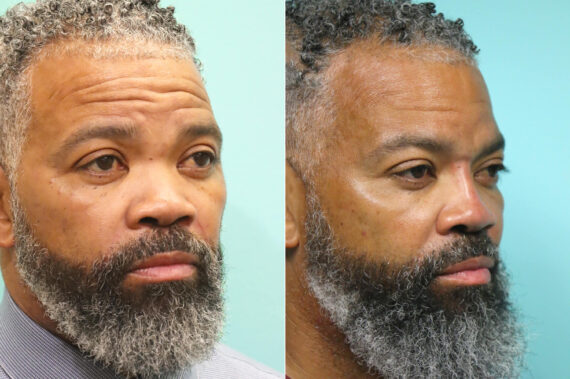 Before and after Male Injections by Dr. Shervin Naderi, Patient 17640