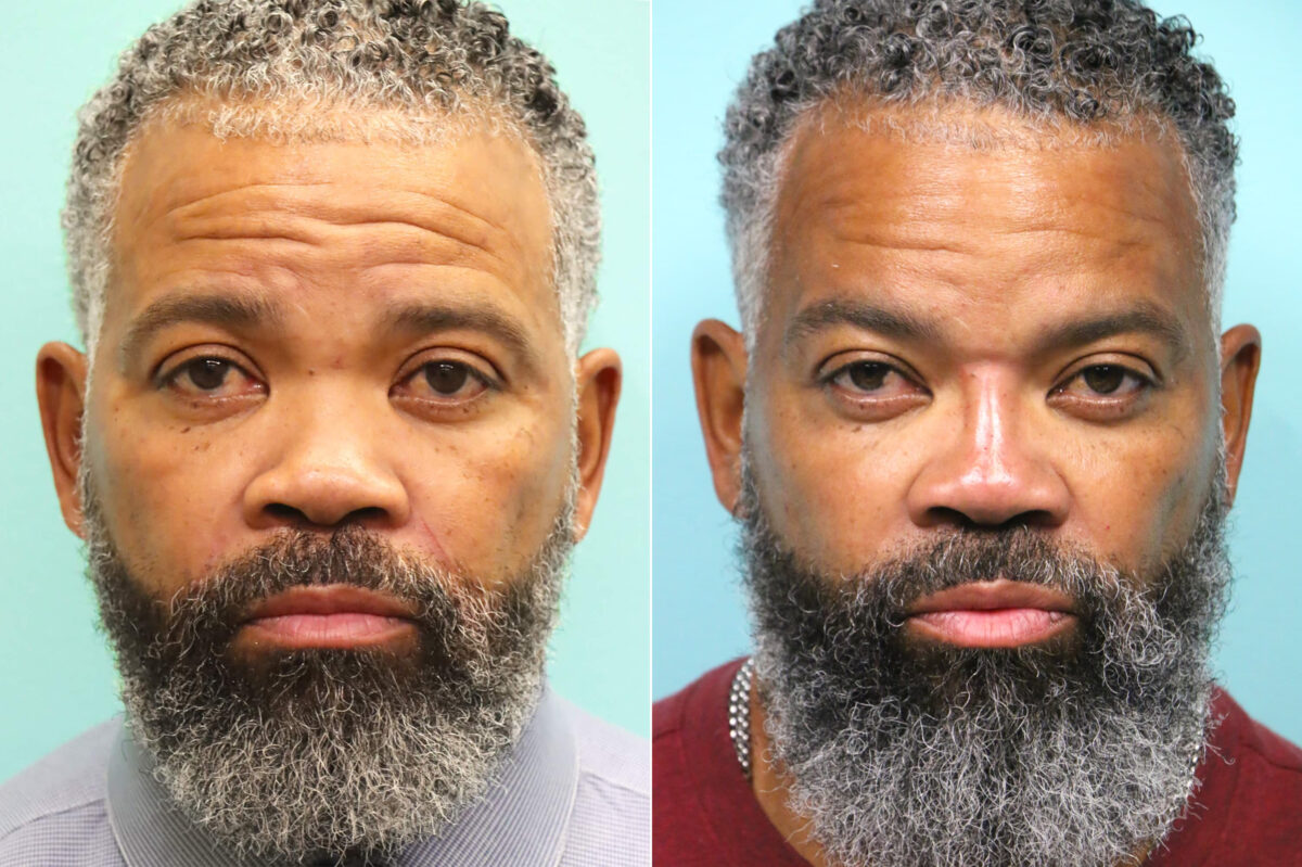 Before and after Male Injections by Dr. Shervin Naderi, Patient 17640