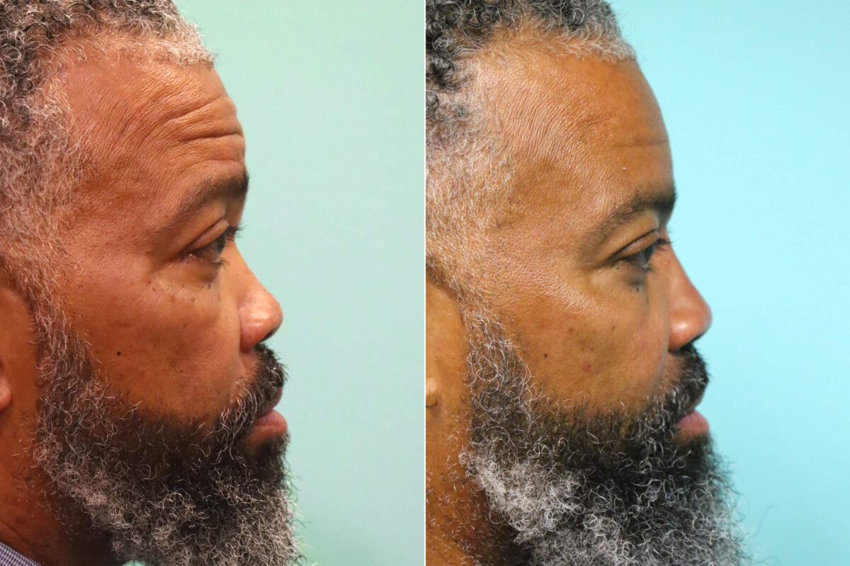 Before and after Male Injections by Dr. Shervin Naderi, Patient 17640