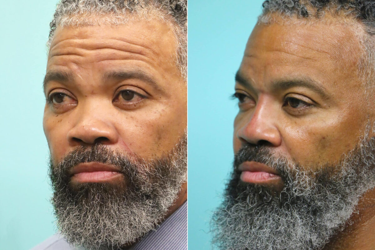 Before and after Male Injections by Dr. Shervin Naderi, Patient 17640