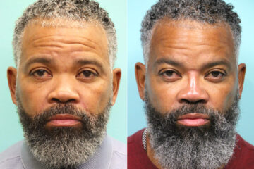 Before and after Male Injections by Dr. Shervin Naderi, Patient 17640