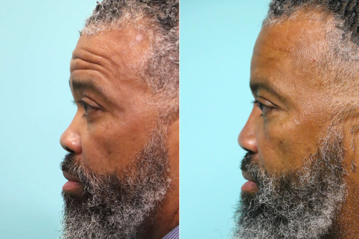 Before and after Male Injections by Dr. Shervin Naderi, Patient 17640