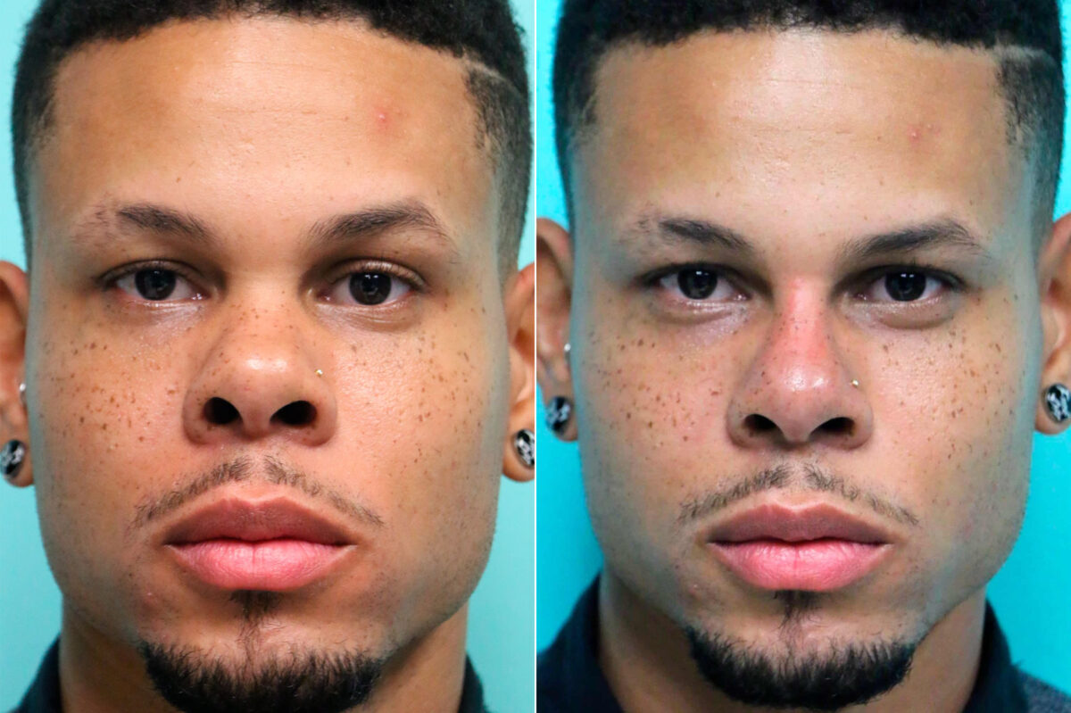 Before and after Male Injections by Dr. Shervin Naderi, Patient 17817