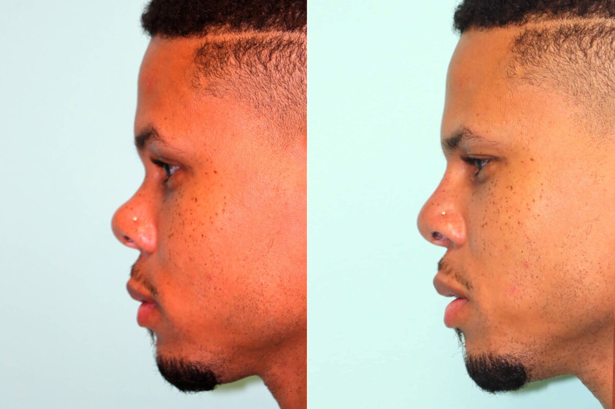 Before and after Male Injections by Dr. Shervin Naderi, Patient 17817