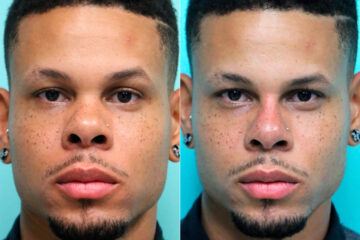 Before and after Male Injections by Dr. Shervin Naderi, Patient 17817