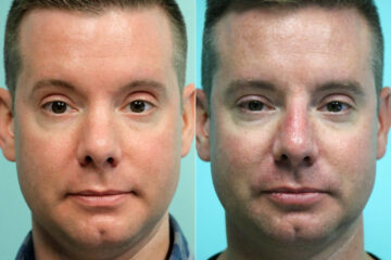 Before and after Male Injections by Dr. Shervin Naderi, Patient 18613