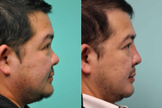 Before and after Male Injections by Dr. Shervin Naderi, Patient 20164