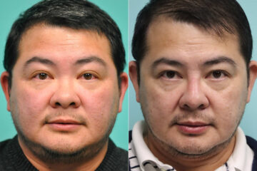 Before and after Male Injections by Dr. Shervin Naderi, Patient 20164