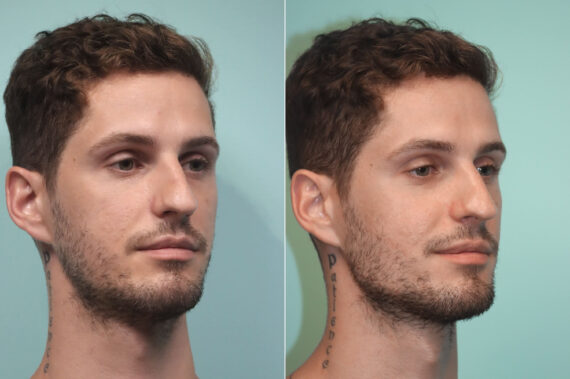 Before and after Male Injections by Dr. Shervin Naderi, Patient 24439