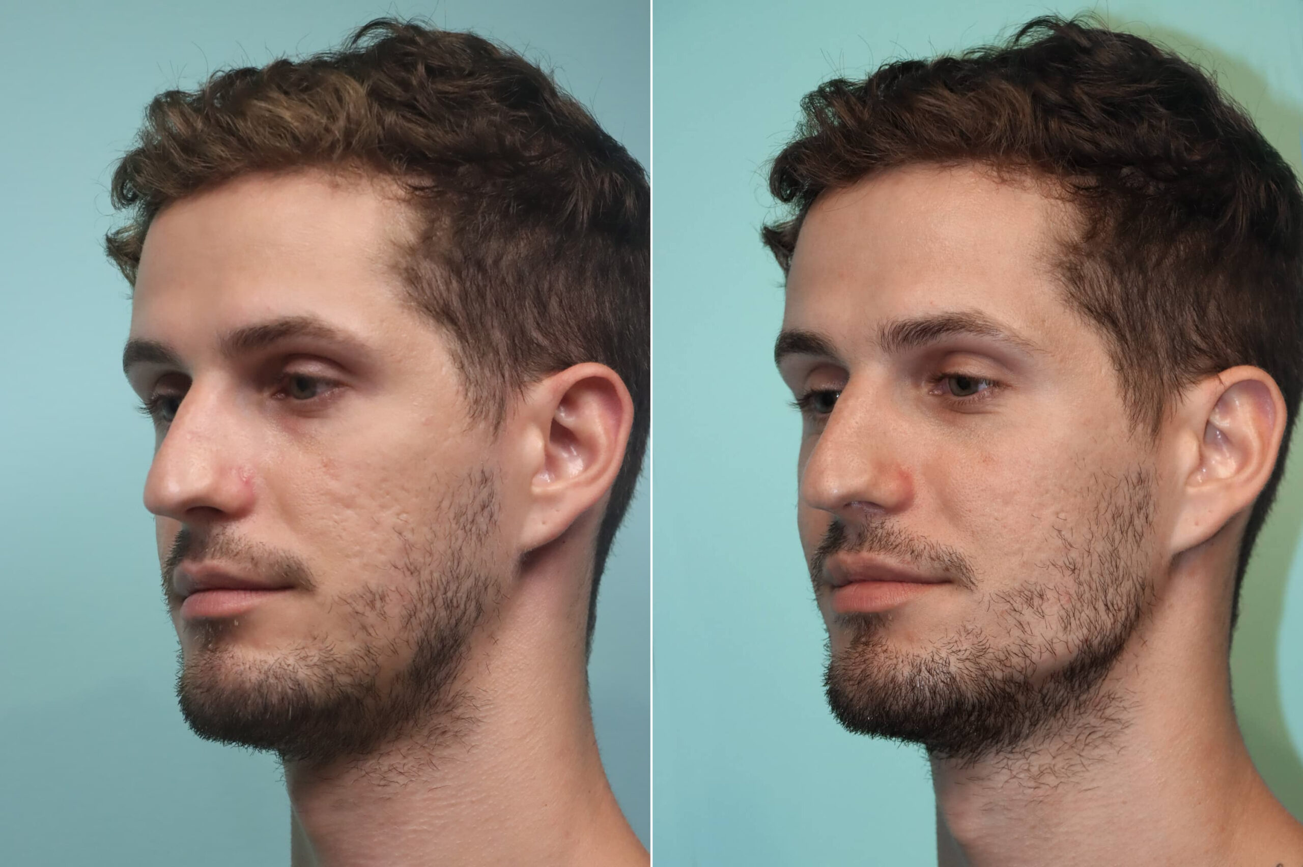 patient-24439-male-injections-before-after