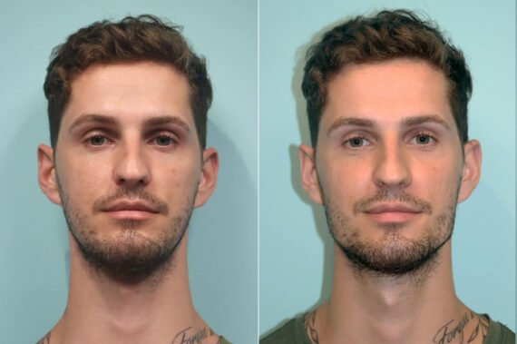 Before and after Male Injections by Dr. Shervin Naderi, Patient 24439