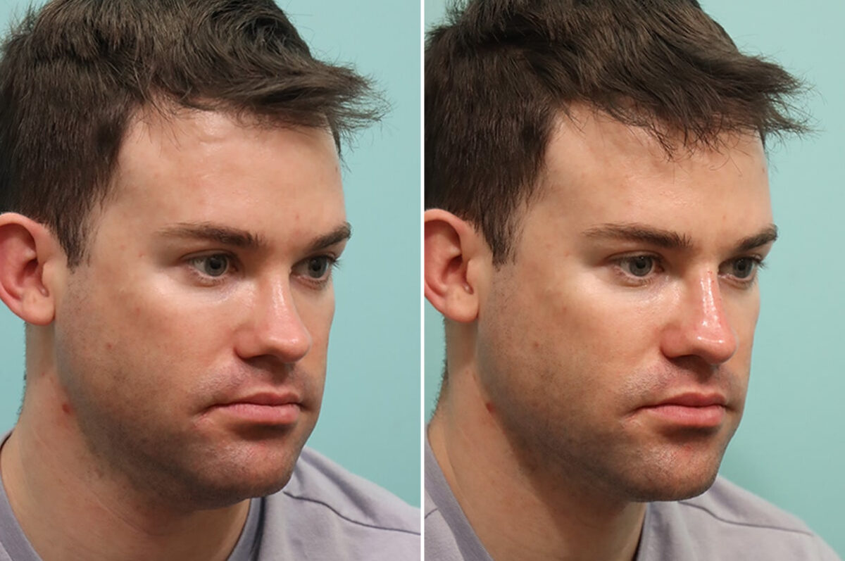 Patient 24556, Male Injections Before and After Photos Before and after Male Injections by Dr. Shervin Naderi, Patient 24556