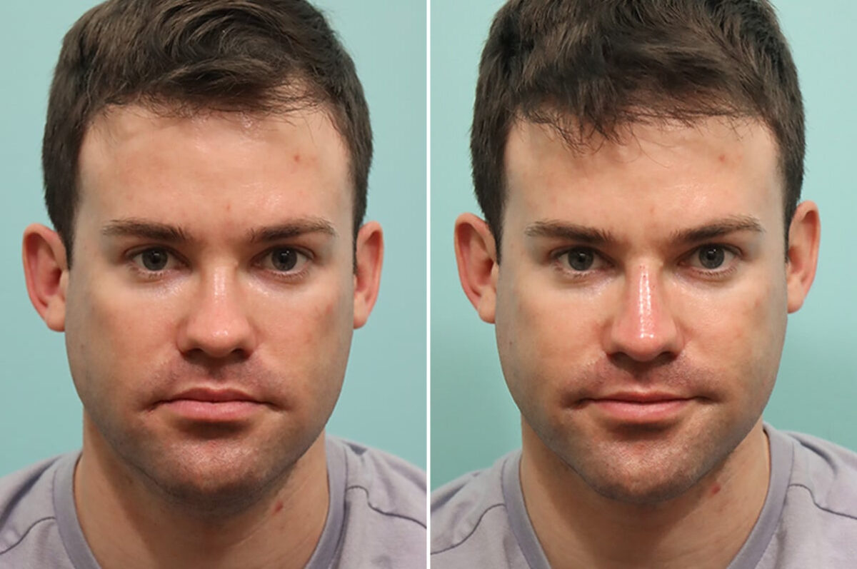 Patient 24556, Male Injections Before and After Photos Before and after Male Injections by Dr. Shervin Naderi, Patient 24556