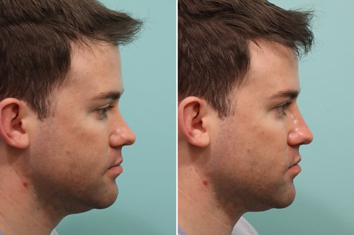 Patient 24556, Male Injections Before and After Photos Before and after Male Injections by Dr. Shervin Naderi, Patient 24556