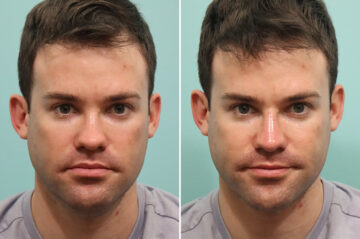 Before and after Male Injections by Dr. Shervin Naderi, Patient 24556