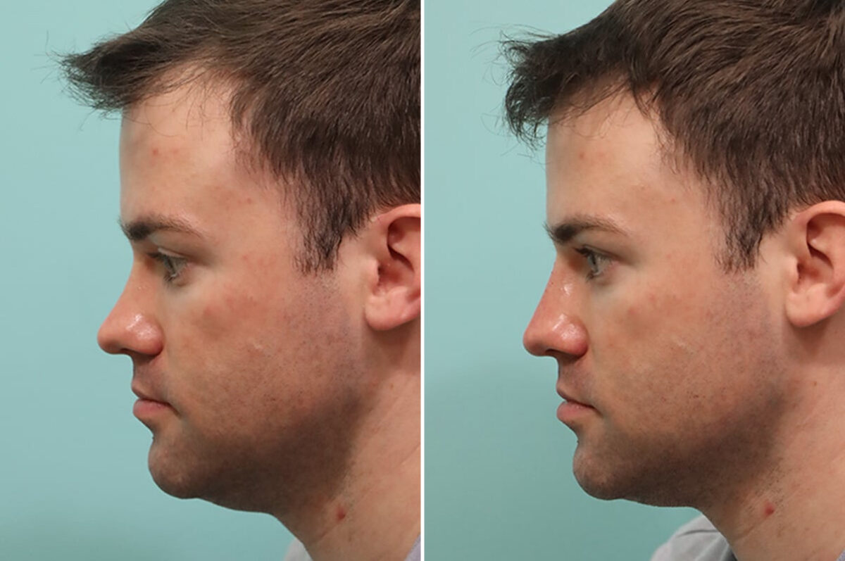 Patient 24556, Male Injections Before and After Photos Before and after Male Injections by Dr. Shervin Naderi, Patient 24556