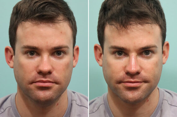 Before and after Male Injections by Dr. Shervin Naderi, Patient 24556