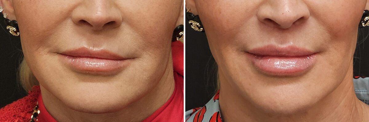 Patient 40939, Lip Lift Before and After Photos Before and after Lip Lift by Dr. Shervin Naderi, Patient 40939