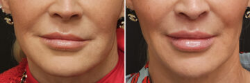 Before and after Lip Lift by Dr. Shervin Naderi, Patient 40939