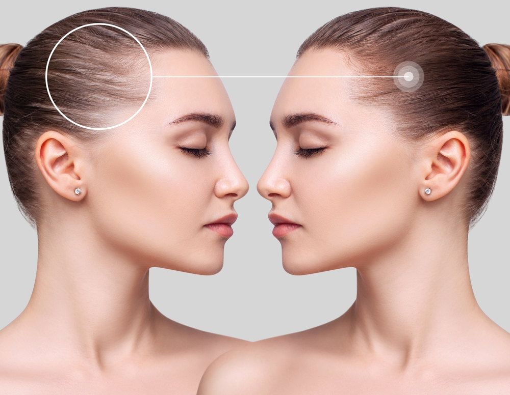 Side-by-side comparison of woman’s hairline before and after PRP hair restoration showing visible regrowth progress