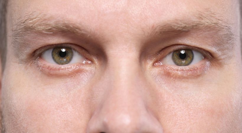 Close-up of male eyes showing reduced hollowness after undereye filler treatment for a refreshed appearance.