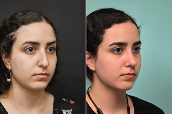 Before and after Rhinoplasty by Dr. Shervin Naderi, Patient 41085