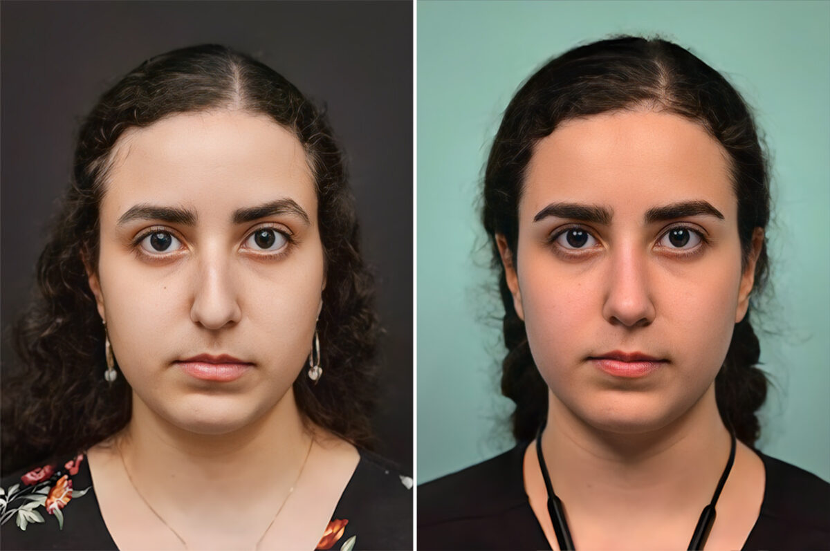 Patient 41085, Rhinoplasty Before and After Photos Before and after Rhinoplasty by Dr. Shervin Naderi, Patient 41085