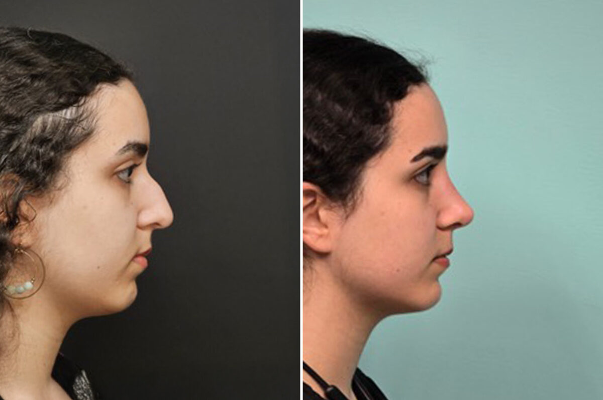 Patient 41085, Rhinoplasty Before and After Photos Before and after Rhinoplasty by Dr. Shervin Naderi, Patient 41085
