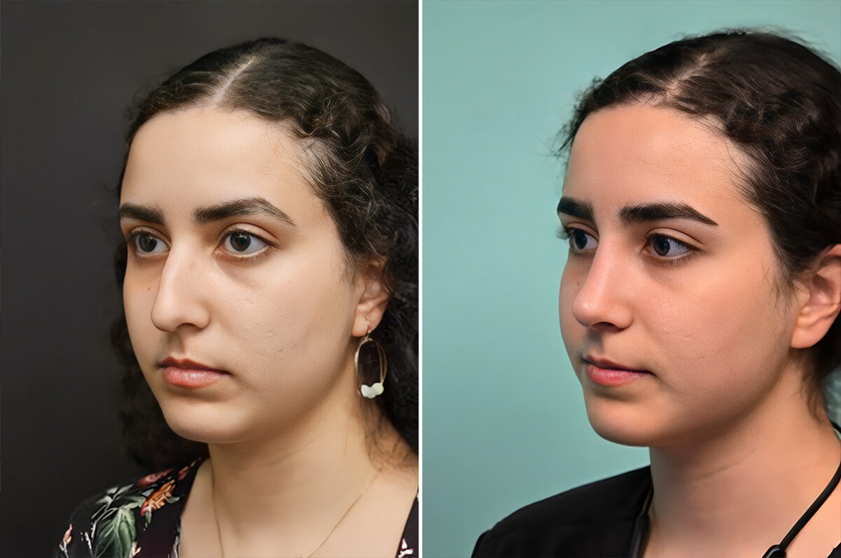 Patient 41085, Rhinoplasty Before and After Photos Before and after Rhinoplasty by Dr. Shervin Naderi, Patient 41085