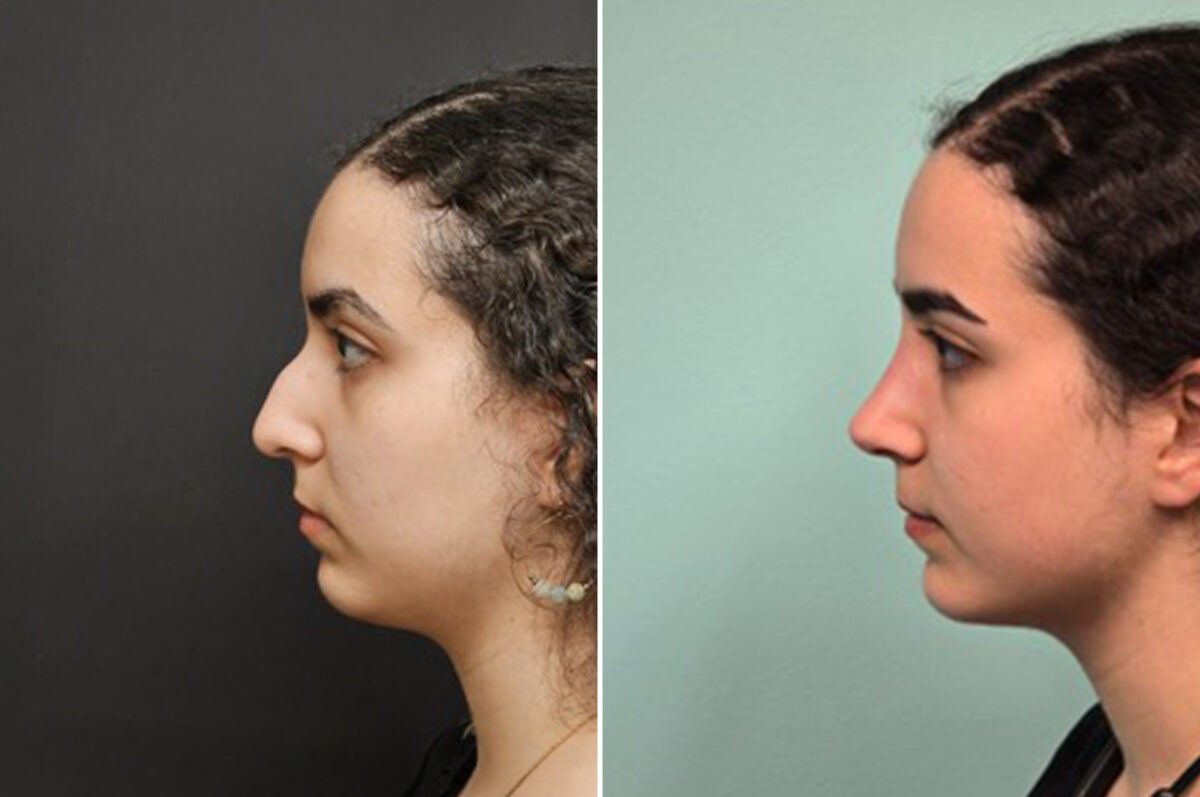Patient 41085, Rhinoplasty Before and After Photos Before and after Rhinoplasty by Dr. Shervin Naderi, Patient 41085