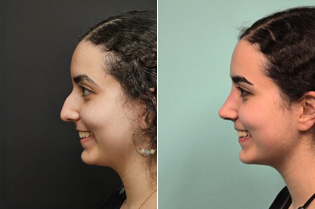 Patient 41085, Rhinoplasty Before and After Photos Before and after Rhinoplasty by Dr. Shervin Naderi, Patient 41085