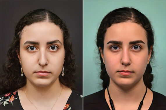 Before and after Rhinoplasty by Dr. Shervin Naderi, Patient 41085