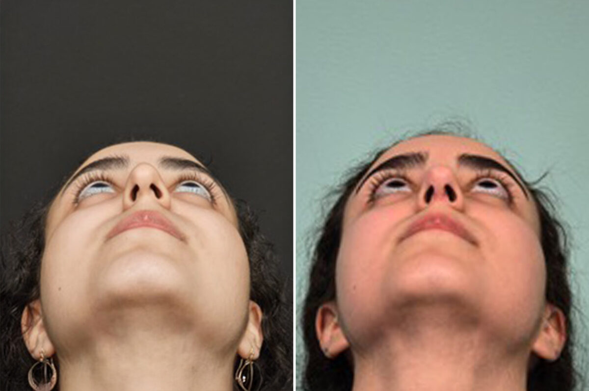 Patient 41085, Rhinoplasty Before and After Photos Before and after Rhinoplasty by Dr. Shervin Naderi, Patient 41085