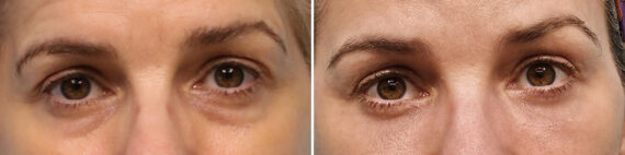 Before and after Blepharoplasty by Dr. Shervin Naderi, Patient 41150