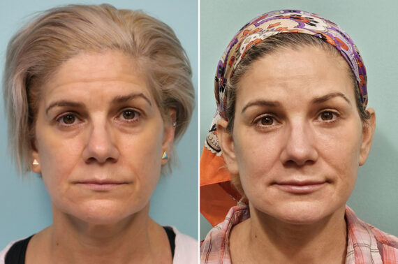 Before and after Blepharoplasty by Dr. Shervin Naderi, Patient 41150