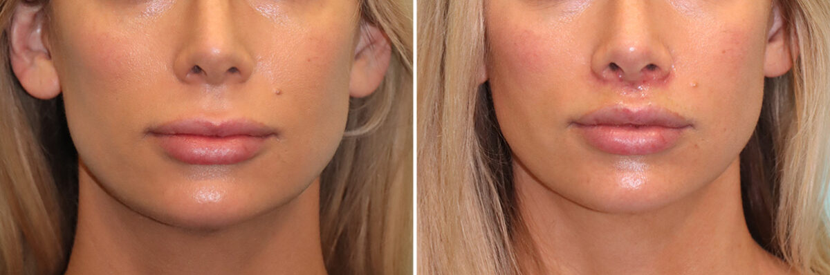 Before and after Lip Lift by Dr. Shervin Naderi, Patient 41411