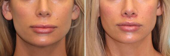 Before and after Lip Lift by Dr. Shervin Naderi, Patient 41411