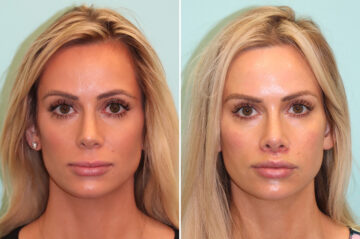 Before and after Lip Lift by Dr. Shervin Naderi, Patient 41411