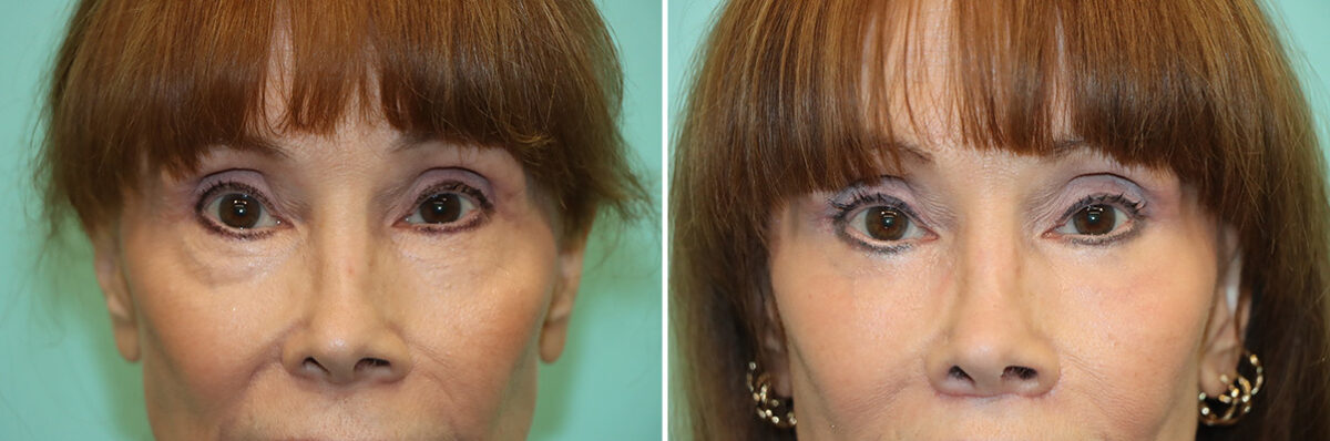 Patient 41426, Blepharoplasty Before and After Photos Before and after Blepharoplasty by Dr. Shervin Naderi, Patient 41426